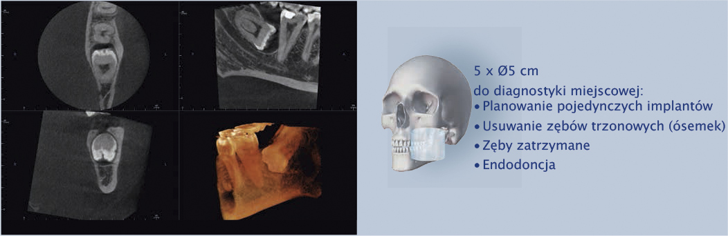 rentgen zębów dla endodoncji