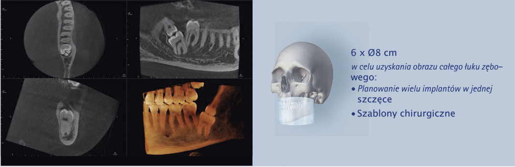 pracownia rentgenowska zdjęcia pod implanty zębów