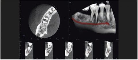 precyzyjna tomografia zębów