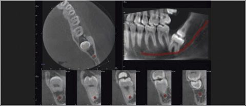 tomografia zębów zredukowany skan