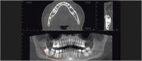 tomografia cyfrowa szczęki zatok
